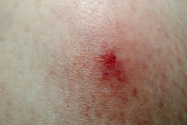 tick bites